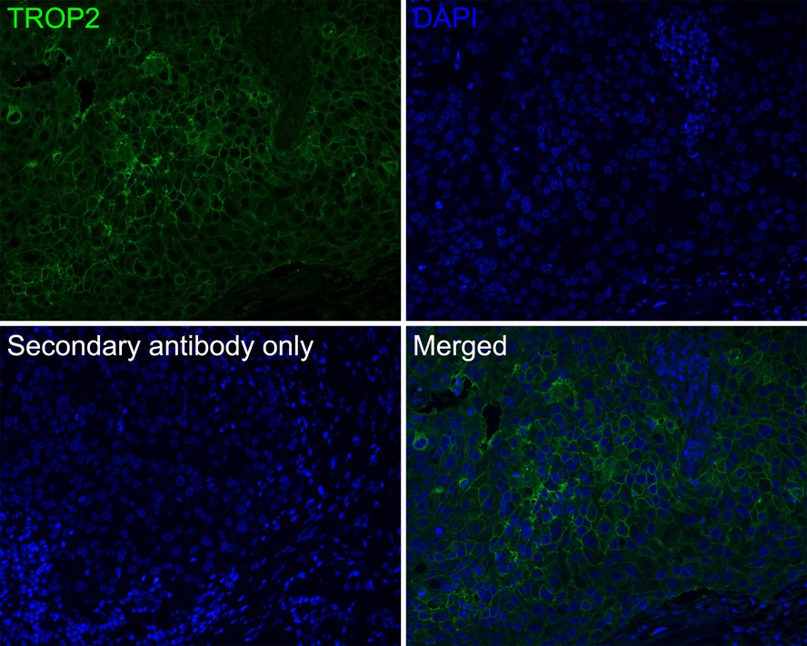 Immunofluorescence analysis of paraffin-embedded human breast carcinoma tissue labeling TROP2 with Rabbit anti-TROP2 antibody (ER1802-60) at 1/85 dilution.<br />
<br />
The section was pre-treated using heat mediated antigen retrieval with Tris-EDTA buffer (pH 9.0) for 20 minutes. The tissues were blocked in 10% negative goat serum for 1 hour at room temperature, washed with PBS, and then probed with the primary antibody (ER1802-60, red) at 1/85 dilution overnight at 4 ℃, washed with PBS.<br />
<br />
Goat Anti-Rabbit IgG H&L (iFluor™ 488, HA1121) was used as the secondary antibody at 1/1,000 dilution. Nuclei were counterstained with DAPI (blue).