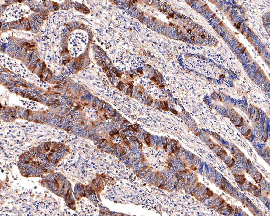 Immunohistochemical analysis of paraffin-embedded human colon carcinoma tissue with Rabbit anti-Cyclin B1 antibody (ET1608-27) at 1/400 dilution.<br />
<br />
The section was pre-treated using heat mediated antigen retrieval with Tris-EDTA buffer (pH 9.0) for 20 minutes. The tissues were blocked in 1% BSA for 20 minutes at room temperature, washed with ddH2O and PBS, and then probed with the primary antibody (ET1608-27) at 1/400 dilution for 1 hour at room temperature. The detection was performed using an HRP conjugated compact polymer system. DAB was used as the chromogen. Tissues were counterstained with hematoxylin and mounted with DPX.