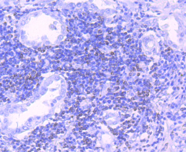 Immunohistochemical analysis of paraffin-embedded human lung carcinoma tissue using anti-Bcl-2 antibody. The section was pre-treated using heat mediated antigen retrieval with Tris-EDTA buffer (pH 8.0-8.4) for 20 minutes.The tissues were blocked in 5% BSA for 30 minutes at room temperature, washed with ddH2O and PBS, and then probed with the primary antibody (ET1702-53, 1/50) for 30 minutes at room temperature. The detection was performed using an HRP conjugated compact polymer system. DAB was used as the chromogen. Tissues were counterstained with hematoxylin and mounted with DPX.