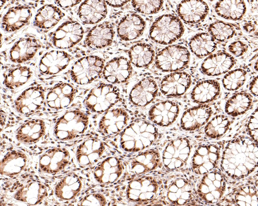 Immunohistochemical analysis of paraffin-embedded human large intestine tissue with Rabbit anti-p95 NBS1 antibody (ET1610-26) at 1/100 dilution.<br />
<br />
The section was pre-treated using heat mediated antigen retrieval with sodium citrate buffer (pH 6.0) for 2 minutes. The tissues were blocked in 1% BSA for 20 minutes at room temperature, washed with ddH2O and PBS, and then probed with the primary antibody (ET1610-26) at 1/100 dilution for 1 hour at room temperature. The detection was performed using an HRP conjugated compact polymer system. DAB was used as the chromogen. Tissues were counterstained with hematoxylin and mounted with DPX.