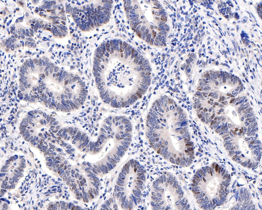 Immunohistochemical analysis of paraffin-embedded human colon carcinoma tissue with Rabbit anti-Phospho-c-Jun(S63) antibody (ET1608-4) at 1/500 dilution.<br />
<br />
The section was pre-treated using heat mediated antigen retrieval with sodium citrate buffer (pH 6.0) for 2 minutes. The tissues were blocked in 1% BSA for 20 minutes at room temperature, washed with ddH2O and PBS, and then probed with the primary antibody (ET1608-4) at 1/500 dilution for 1 hour at room temperature. The detection was performed using an HRP conjugated compact polymer system. DAB was used as the chromogen. Tissues were counterstained with hematoxylin and mounted with DPX.