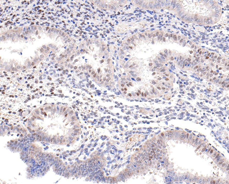 Immunohistochemical analysis of paraffin-embedded human endometrial tissue with Rabbit anti-Phospho-c-Jun(S63) antibody (ET1608-4) at 1/500 dilution.<br />
<br />
The section was pre-treated using heat mediated antigen retrieval with sodium citrate buffer (pH 6.0) for 2 minutes. The tissues were blocked in 1% BSA for 20 minutes at room temperature, washed with ddH2O and PBS, and then probed with the primary antibody (ET1608-4) at 1/500 dilution for 1 hour at room temperature. The detection was performed using an HRP conjugated compact polymer system. DAB was used as the chromogen. Tissues were counterstained with hematoxylin and mounted with DPX.