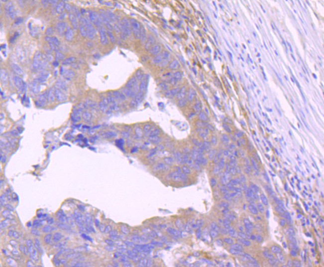 Immunohistochemical analysis of paraffin-embedded human colon cancer tissue with Rabbit anti-STAT2 antibody (ET1702-18) at 1/50 dilution.<br />
<br />
The section was pre-treated using heat mediated antigen retrieval with Tris-EDTA buffer (pH 9.0) for 20 minutes. The tissues were blocked in 1% BSA for 20 minutes at room temperature, washed with ddH2O and PBS, and then probed with the primary antibody (ET1702-18) at 1/400 dilution for 1 hour at room temperature. The detection was performed using an HRP conjugated compact polymer system. DAB was used as the chromogen. Tissues were counterstained with hematoxylin and mounted with DPX.