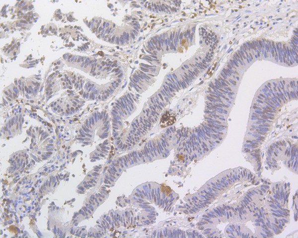 Immunohistochemical analysis of paraffin-embedded human colon carcinoma tissue with Mouse anti-MED12 antibody (HA500331) at 1/500 dilution.<br />
<br />
The section was pre-treated using heat mediated antigen retrieval with Tris-EDTA buffer (pH 9.0) for 20 minutes. The tissues were blocked in 1% BSA for 20 minutes at room temperature, washed with ddH2O and PBS, and then probed with the primary antibody (HA500331) at 1/500 dilution for 1 hour at room temperature. The detection was performed using an HRP conjugated compact polymer system. DAB was used as the chromogen. Tissues were counterstained with hematoxylin and mounted with DPX.