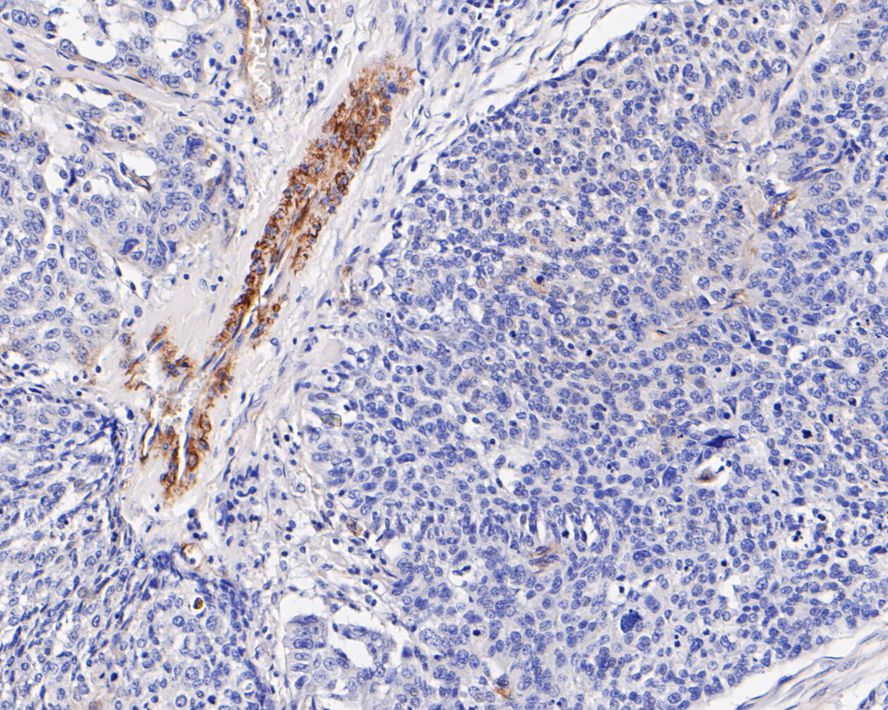 Immunohistochemical analysis of paraffin-embedded human lung carcinoma tissue with Mouse anti-Caveolin-1 antibody (HA601005) at 1/1,000 dilution.<br />
<br />
The section was pre-treated using heat mediated antigen retrieval with Tris-EDTA buffer (pH 9.0) for 20 minutes. The tissues were blocked in 1% BSA for 20 minutes at room temperature, washed with ddH2O and PBS, and then probed with the primary antibody (HA601005) at 1/1,000 dilution for 1 hour at room temperature. The detection was performed using an HRP conjugated compact polymer system. DAB was used as the chromogen. Tissues were counterstained with hematoxylin and mounted with DPX.