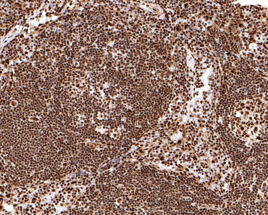 Immunohistochemical analysis of paraffin-embedded human lymph nodes tissue with Rabbit anti-BRCA1 antibody (HA601009) at 1/1,500 dilution.<br />
<br />
The section was pre-treated using heat mediated antigen retrieval with sodium citrate buffer (pH 6.0) for 2 minutes. The tissues were blocked in 1% BSA for 20 minutes at room temperature, washed with ddH2O and PBS, and then probed with the primary antibody (HA601009) at 1/1,500 dilution for 1 hour at room temperature. The detection was performed using an HRP conjugated compact polymer system. DAB was used as the chromogen. Tissues were counterstained with hematoxylin and mounted with DPX.