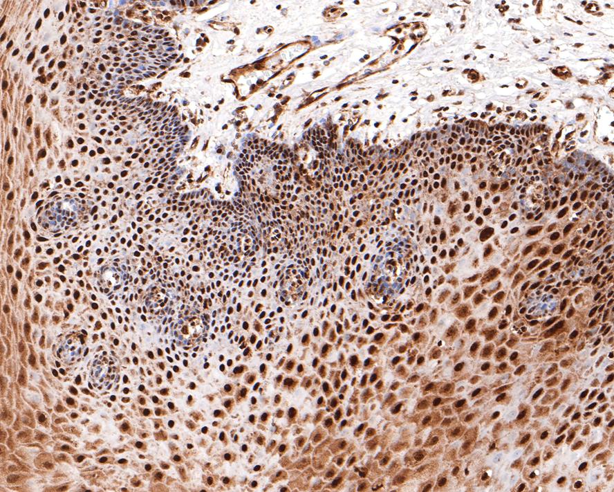 Immunohistochemical analysis of paraffin-embedded human skin tissue with Rabbit anti-BRCA1 antibody (HA601009) at 1/1,500 dilution.<br />
<br />
The section was pre-treated using heat mediated antigen retrieval with sodium citrate buffer (pH 6.0) for 2 minutes. The tissues were blocked in 1% BSA for 20 minutes at room temperature, washed with ddH2O and PBS, and then probed with the primary antibody (HA601009) at 1/1,500 dilution for 1 hour at room temperature. The detection was performed using an HRP conjugated compact polymer system. DAB was used as the chromogen. Tissues were counterstained with hematoxylin and mounted with DPX.