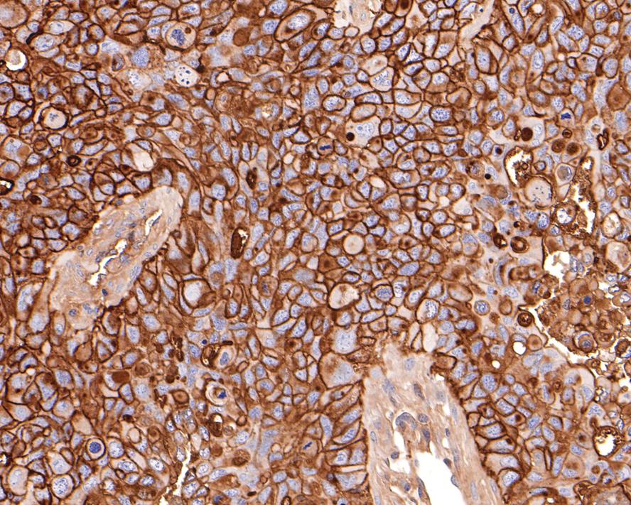 Immunohistochemical analysis of paraffin-embedded NCI-H441 xenograft tissue with Mouse anti-CD73 antibody (HA601010) at 1/600 dilution.<br />
<br />
The section was pre-treated using heat mediated antigen retrieval with Tris-EDTA buffer (pH 9.0) for 20 minutes. The tissues were blocked in 1% BSA for 20 minutes at room temperature, washed with ddH2O and PBS, and then probed with the primary antibody (HA601010) at 1/600 dilution for 1 hour at room temperature. The detection was performed using an HRP conjugated compact polymer system. DAB was used as the chromogen. Tissues were counterstained with hematoxylin and mounted with DPX.