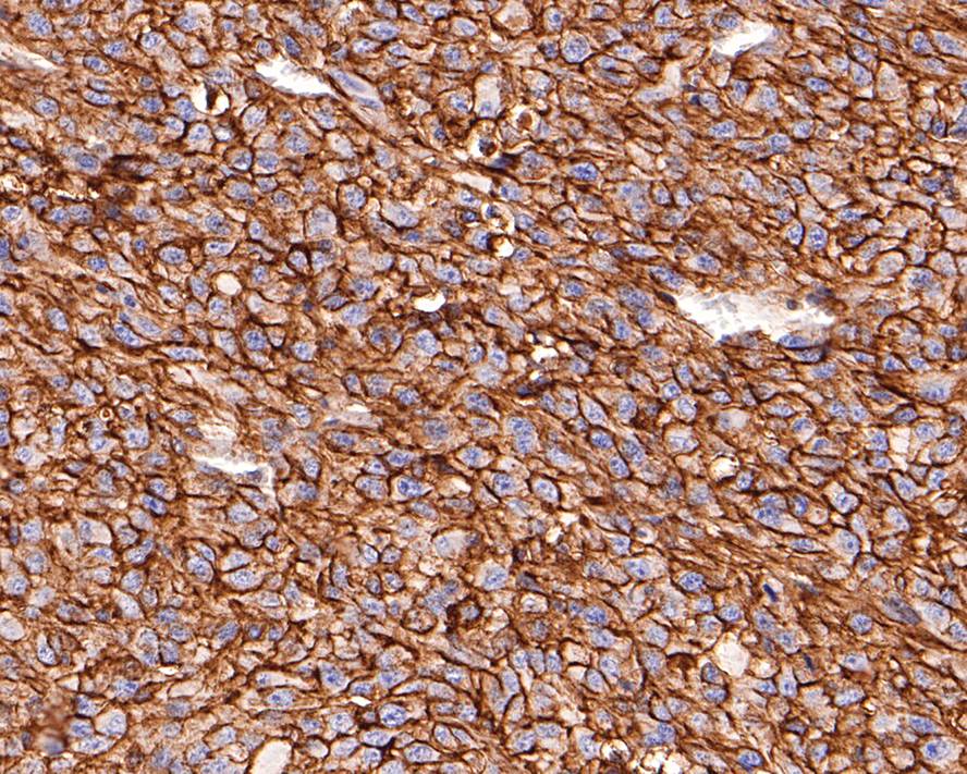 Immunohistochemical analysis of paraffin-embedded U87MG xenograft tissue with Mouse anti-CD73 antibody (HA601010) at 1/200 dilution.<br />
<br />
The section was pre-treated using heat mediated antigen retrieval with Tris-EDTA buffer (pH 9.0) for 20 minutes. The tissues were blocked in 1% BSA for 20 minutes at room temperature, washed with ddH2O and PBS, and then probed with the primary antibody (HA601010) at 1/200 dilution for 1 hour at room temperature. The detection was performed using an HRP conjugated compact polymer system. DAB was used as the chromogen. Tissues were counterstained with hematoxylin and mounted with DPX.