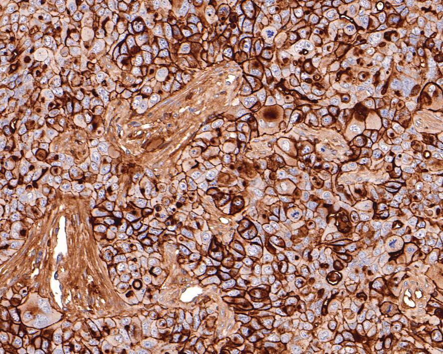 Immunohistochemical analysis of paraffin-embedded NCI-H441 xenograft tissue with Mouse anti-CD73 antibody (HA601011) at 1/600 dilution.<br />
<br />
The section was pre-treated using heat mediated antigen retrieval with Tris-EDTA buffer (pH 9.0) for 20 minutes. The tissues were blocked in 1% BSA for 20 minutes at room temperature, washed with ddH2O and PBS, and then probed with the primary antibody (HA601011) at 1/600 dilution for 1 hour at room temperature. The detection was performed using an HRP conjugated compact polymer system. DAB was used as the chromogen. Tissues were counterstained with hematoxylin and mounted with DPX.