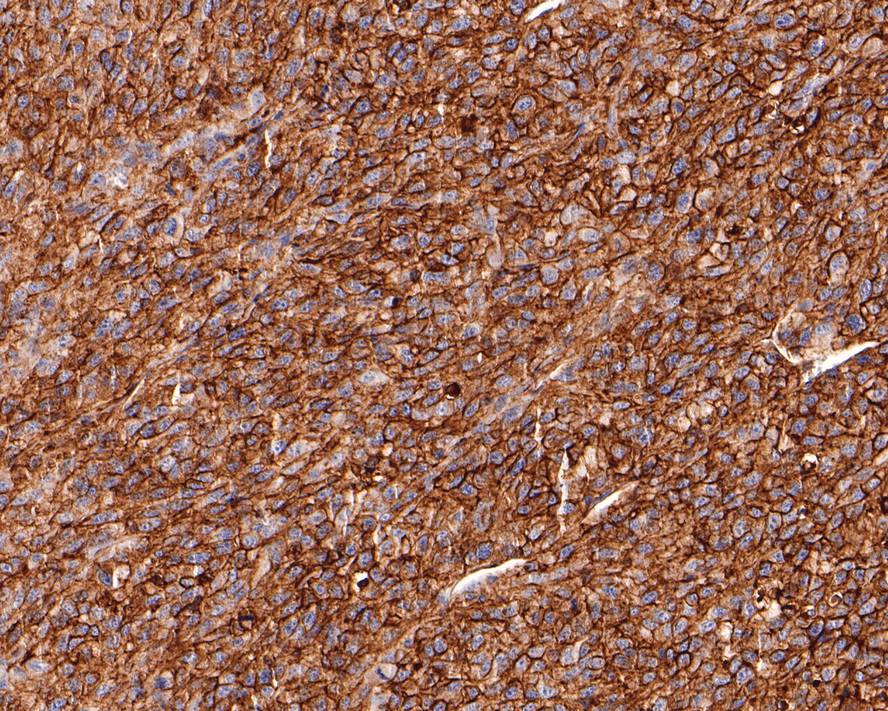Immunohistochemical analysis of paraffin-embedded U87MG xenograft tissue with Mouse anti-CD73 antibody (HA601011) at 1/200 dilution.<br />
<br />
The section was pre-treated using heat mediated antigen retrieval with Tris-EDTA buffer (pH 9.0) for 20 minutes. The tissues were blocked in 1% BSA for 20 minutes at room temperature, washed with ddH2O and PBS, and then probed with the primary antibody (HA601011) at 1/200 dilution for 1 hour at room temperature. The detection was performed using an HRP conjugated compact polymer system. DAB was used as the chromogen. Tissues were counterstained with hematoxylin and mounted with DPX.