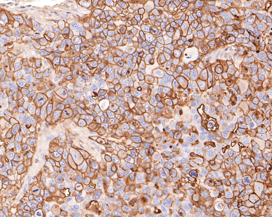 Immunohistochemical analysis of paraffin-embedded NCI-H441 xenograft tissue with Mouse anti-CD73 antibody (HA601012) at 1/600 dilution.<br />
<br />
The section was pre-treated using heat mediated antigen retrieval with Tris-EDTA buffer (pH 9.0) for 20 minutes. The tissues were blocked in 1% BSA for 20 minutes at room temperature, washed with ddH2O and PBS, and then probed with the primary antibody (HA601012) at 1/600 dilution for 1 hour at room temperature. The detection was performed using an HRP conjugated compact polymer system. DAB was used as the chromogen. Tissues were counterstained with hematoxylin and mounted with DPX.