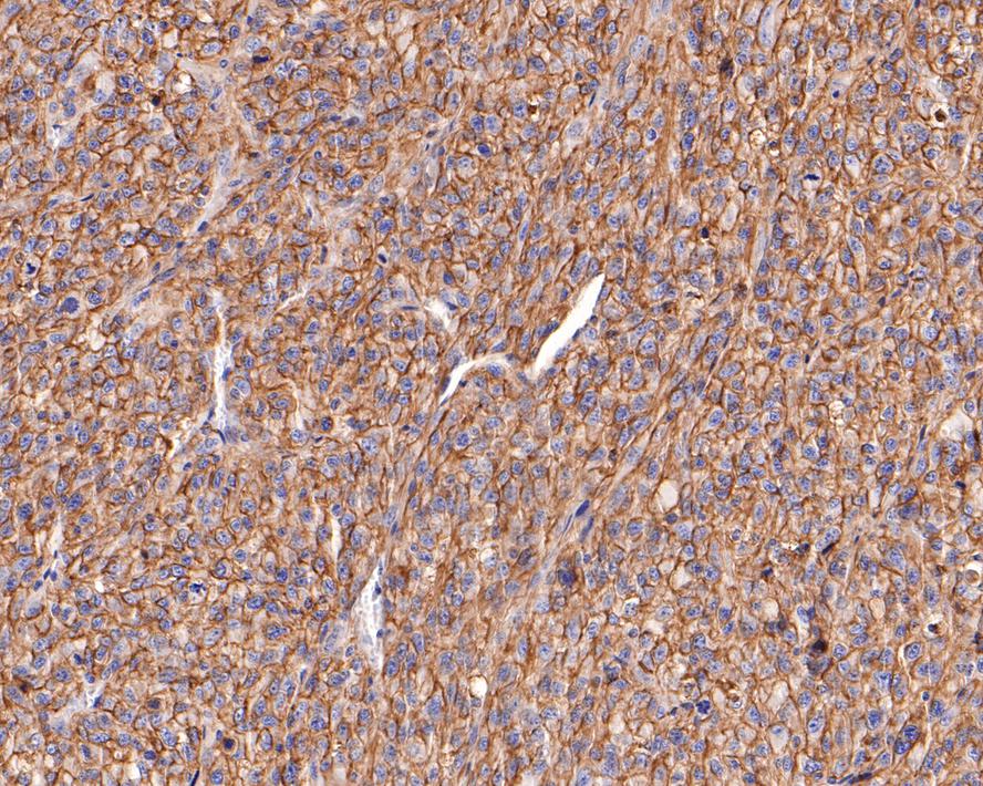 Immunohistochemical analysis of paraffin-embedded U87MG xenograft tissue with Mouse anti-CD73 antibody (HA601012) at 1/200 dilution.<br />
<br />
The section was pre-treated using heat mediated antigen retrieval with Tris-EDTA buffer (pH 9.0) for 20 minutes. The tissues were blocked in 1% BSA for 20 minutes at room temperature, washed with ddH2O and PBS, and then probed with the primary antibody (HA601012) at 1/200 dilution for 1 hour at room temperature. The detection was performed using an HRP conjugated compact polymer system. DAB was used as the chromogen. Tissues were counterstained with hematoxylin and mounted with DPX.