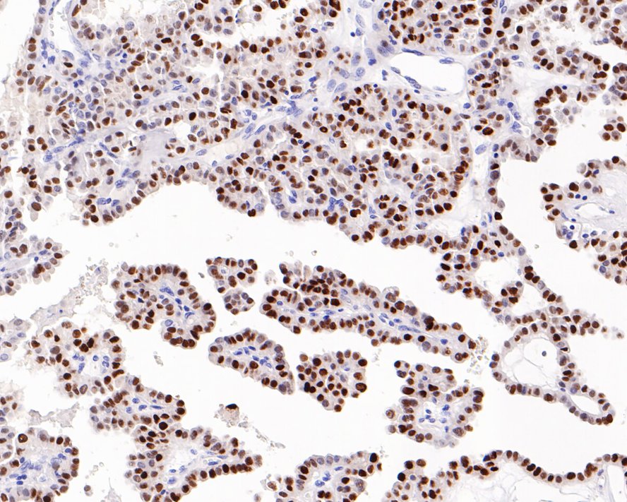 Immunohistochemical analysis of paraffin-embedded human thyroid carcinoma tissue with Rabbit anti-p21 antibody (HA601018) at 1/400 dilution.<br />
<br />
The section was pre-treated using heat mediated antigen retrieval with Tris-EDTA buffer (pH 9.0) for 20 minutes. The tissues were blocked in 1% BSA for 20 minutes at room temperature, washed with ddH2O and PBS, and then probed with the primary antibody (HA601018) at 1/400 dilution for 1 hour at room temperature. The detection was performed using an HRP conjugated compact polymer system. DAB was used as the chromogen. Tissues were counterstained with hematoxylin and mounted with DPX.