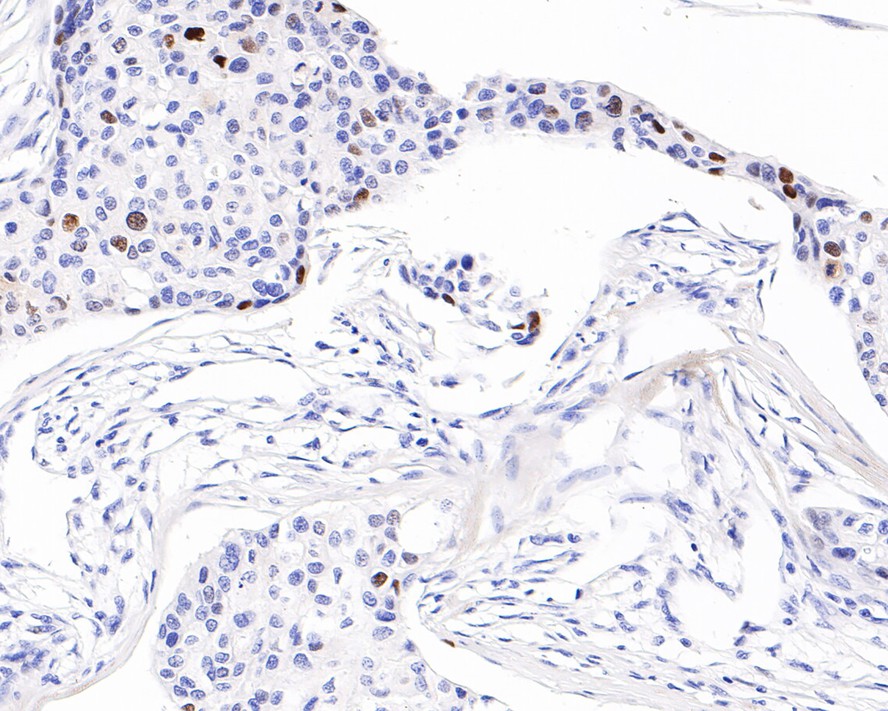 Immunohistochemical analysis of paraffin-embedded human breast carcinoma tissue with Rabbit anti-p21 antibody (HA601018) at 1/200 dilution.<br />
<br />
The section was pre-treated using heat mediated antigen retrieval with Tris-EDTA buffer (pH 9.0) for 20 minutes. The tissues were blocked in 1% BSA for 20 minutes at room temperature, washed with ddH2O and PBS, and then probed with the primary antibody (HA601018) at 1/200 dilution for 1 hour at room temperature. The detection was performed using an HRP conjugated compact polymer system. DAB was used as the chromogen. Tissues were counterstained with hematoxylin and mounted with DPX.
