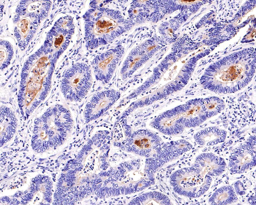 Immunohistochemical analysis of paraffin-embedded human colon carcinoma tissue with Mouse anti-CD133 antibody (HA601024) at 1/600 dilution.<br />
<br />
The section was pre-treated using heat mediated antigen retrieval with Tris-EDTA buffer (pH 9.0) for 20 minutes. The tissues were blocked in 1% BSA for 20 minutes at room temperature, washed with ddH2O and PBS, and then probed with the primary antibody (HA601024) at 1/600 dilution for 1 hour at room temperature. The detection was performed using an HRP conjugated compact polymer system. DAB was used as the chromogen. Tissues were counterstained with hematoxylin and mounted with DPX.