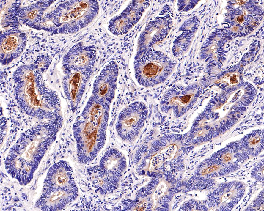 Immunohistochemical analysis of paraffin-embedded human colon carcinoma tissue with Mouse anti-CD133 antibody (HA601025) at 1/600 dilution.<br />
<br />
The section was pre-treated using heat mediated antigen retrieval with Tris-EDTA buffer (pH 9.0) for 20 minutes. The tissues were blocked in 1% BSA for 20 minutes at room temperature, washed with ddH2O and PBS, and then probed with the primary antibody (HA601025) at 1/600 dilution for 1 hour at room temperature. The detection was performed using an HRP conjugated compact polymer system. DAB was used as the chromogen. Tissues were counterstained with hematoxylin and mounted with DPX.