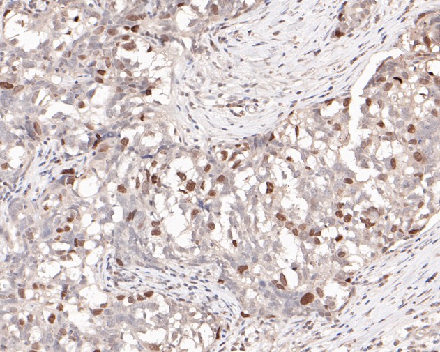 Immunohistochemical analysis of paraffin-embedded human breast carcinoma tissue with Mouse anti-Topoisomerase II alpha antibody (HA601028) at 1/500 dilution.<br />
<br />
The section was pre-treated using heat mediated antigen retrieval with Tris-EDTA buffer (pH 9.0) for 20 minutes. The tissues were blocked in 1% BSA for 20 minutes at room temperature, washed with ddH2O and PBS, and then probed with the primary antibody (HA601028) at 1/500 dilution for 1 hour at room temperature. The detection was performed using an HRP conjugated compact polymer system. DAB was used as the chromogen. Tissues were counterstained with hematoxylin and mounted with DPX.