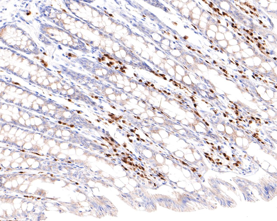 Immunohistochemical analysis of paraffin-embedded human lymph nodes tissue with Mouse anti-MUM1 antibody (HA601030) at 1/2,000 dilution.<br />
<br />
The section was pre-treated using heat mediated antigen retrieval with sodium citrate buffer (pH 6.0) for 2 minutes. The tissues were blocked in 1% BSA for 20 minutes at room temperature, washed with ddH2O and PBS, and then probed with the primary antibody (HA601030) at 1/2,000 dilution for 1 hour at room temperature. The detection was performed using an HRP conjugated compact polymer system. DAB was used as the chromogen. Tissues were counterstained with hematoxylin and mounted with DPX.