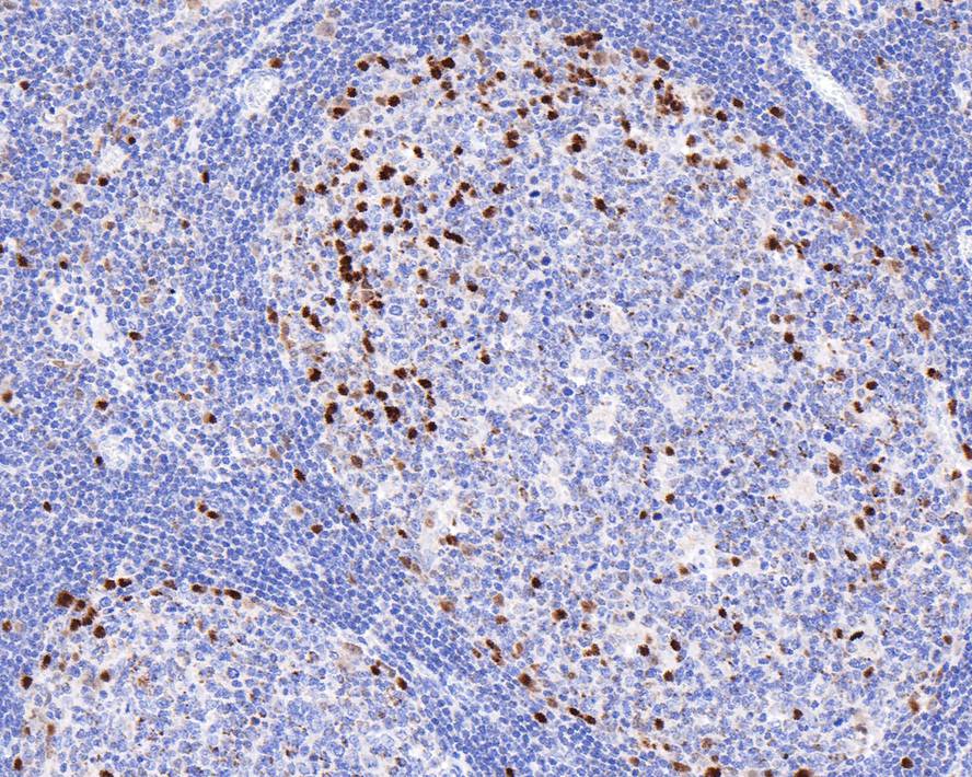 Immunohistochemical analysis of paraffin-embedded human lymph nodes tissue with Mouse anti-MUM1 antibody (HA601031) at 1/2,000 dilution.<br />
<br />
The section was pre-treated using heat mediated antigen retrieval with sodium citrate buffer (pH 6.0) for 2 minutes. The tissues were blocked in 1% BSA for 20 minutes at room temperature, washed with ddH2O and PBS, and then probed with the primary antibody (HA601031) at 1/2,000 dilution for 1 hour at room temperature. The detection was performed using an HRP conjugated compact polymer system. DAB was used as the chromogen. Tissues were counterstained with hematoxylin and mounted with DPX.