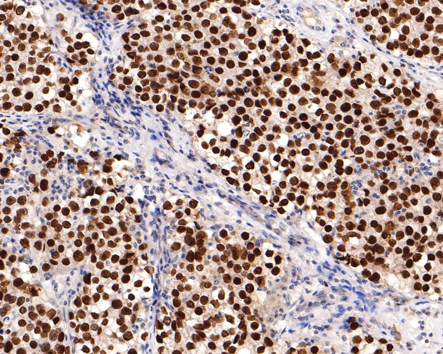 Immunohistochemical analysis of paraffin-embedded human seminoma tissue with Mouse anti-Sall4 antibody (HA601041) at 1/600 dilution.<br />
<br />
The section was pre-treated using heat mediated antigen retrieval with sodium citrate buffer (pH 6.0) for 2 minutes. The tissues were blocked in 1% BSA for 20 minutes at room temperature, washed with ddH2O and PBS, and then probed with the primary antibody (HA601041) at 1/600 dilution for 1 hour at room temperature. The detection was performed using an HRP conjugated compact polymer system. DAB was used as the chromogen. Tissues were counterstained with hematoxylin and mounted with DPX.