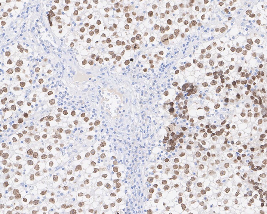 Immunohistochemical analysis of paraffin-embedded human seminoma tissue with Mouse anti-Sall4 antibody (HA601042) at 1/600 dilution.<br />
<br />
The section was pre-treated using heat mediated antigen retrieval with sodium citrate buffer (pH 6.0) for 2 minutes. The tissues were blocked in 1% BSA for 20 minutes at room temperature, washed with ddH2O and PBS, and then probed with the primary antibody (HA601042) at 1/600 dilution for 1 hour at room temperature. The detection was performed using an HRP conjugated compact polymer system. DAB was used as the chromogen. Tissues were counterstained with hematoxylin and mounted with DPX.