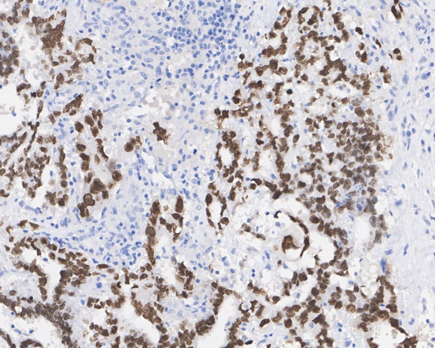 Immunohistochemical analysis of paraffin-embedded human embryonal carcinoma tissue with Mouse anti-Sall4 antibody (HA601042) at 1/2,000 dilution.<br />
<br />
The section was pre-treated using heat mediated antigen retrieval with sodium citrate buffer (pH 6.0) for 2 minutes. The tissues were blocked in 1% BSA for 20 minutes at room temperature, washed with ddH2O and PBS, and then probed with the primary antibody (HA601042) at 1/2,000 dilution for 1 hour at room temperature. The detection was performed using an HRP conjugated compact polymer system. DAB was used as the chromogen. Tissues were counterstained with hematoxylin and mounted with DPX.