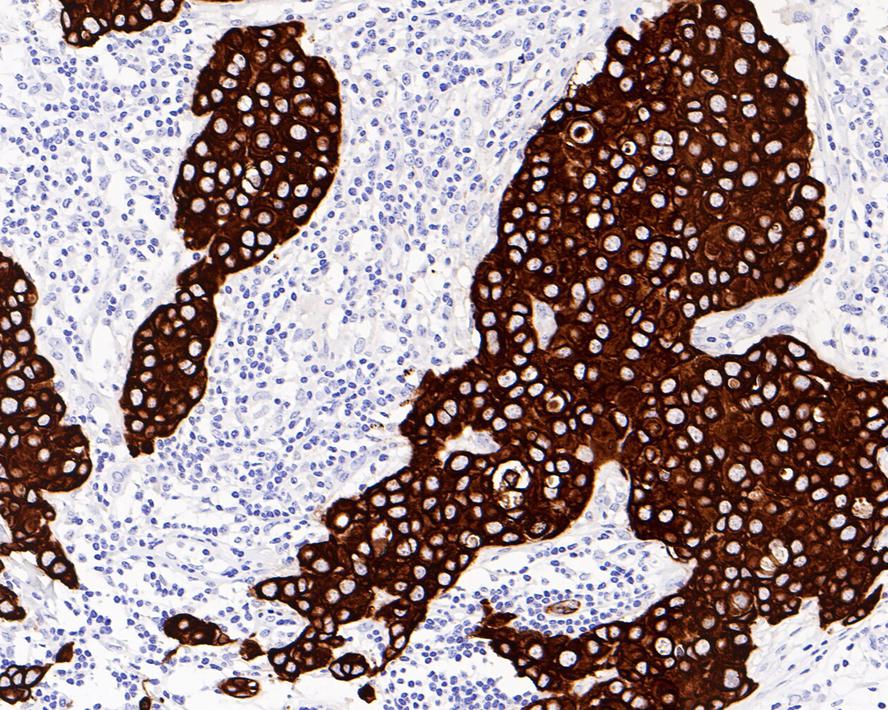 Immunohistochemical analysis of paraffin-embedded human breast carcinoma tissue with Mouse anti-Cytokeratin 7 antibody (EM0702) at 1/200 dilution.<br />
<br />
The section was pre-treated using heat mediated antigen retrieval with Tris-EDTA buffer (pH 9.0) for 20 minutes. The tissues were blocked in 1% BSA for 20 minutes at room temperature, washed with ddH2O and PBS, and then probed with the primary antibody (EM0702) at 1/200 dilution for 1 hour at room temperature. The detection was performed using an HRP conjugated compact polymer system. DAB was used as the chromogen. Tissues were counterstained with hematoxylin and mounted with DPX.