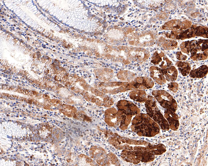 Immunohistochemical analysis of paraffin-embedded human liver tissue with Rabbit anti-ADFP antibody (ET1704-17) at 1/100 dilution.<br />
<br />
The section was pre-treated using heat mediated antigen retrieval with Tris-EDTA buffer (pH 9.0) for 20 minutes. The tissues were blocked in 1% BSA for 20 minutes at room temperature, washed with ddH2O and PBS, and then probed with the primary antibody (ET1704-17) at 1/100 dilution for 1 hour at room temperature. The detection was performed using an HRP conjugated compact polymer system. DAB was used as the chromogen. Tissues were counterstained with hematoxylin and mounted with DPX.