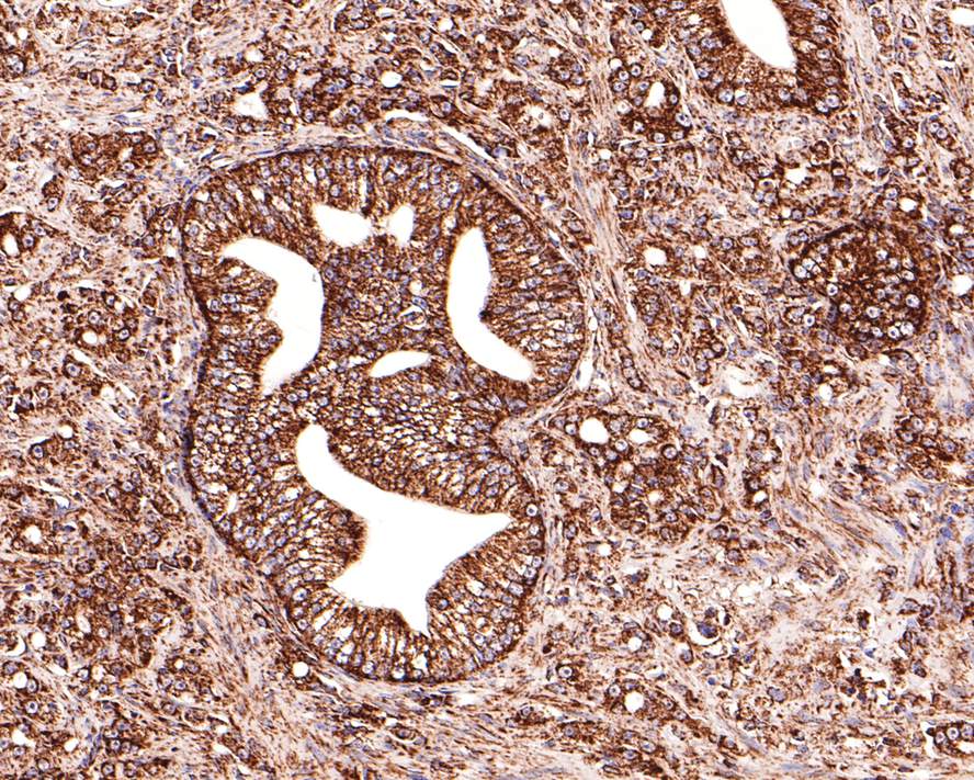 Immunohistochemical analysis of paraffin-embedded human prostate carcinoma tissue with Rabbit anti-PBR antibody (ET1601-19) at 1/400 dilution.<br />
<br />
The section was pre-treated using heat mediated antigen retrieval with Tris-EDTA buffer (pH 9.0) for 20 minutes. The tissues were blocked in 1% BSA for 20 minutes at room temperature, washed with ddH2O and PBS, and then probed with the primary antibody (ET1601-19) at 1/400 dilution for 1 hour at room temperature. The detection was performed using an HRP conjugated compact polymer system. DAB was used as the chromogen. Tissues were counterstained with hematoxylin and mounted with DPX.