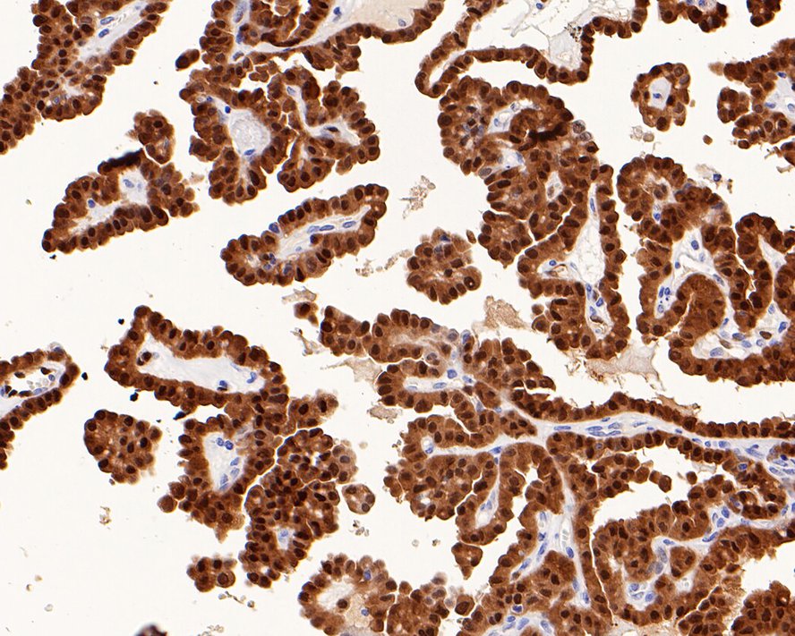 Immunohistochemical analysis of paraffin-embedded human thyroid carcinoma tissue with Rabbit anti-Erk1 (pT202/pY204) + Erk2 (pT185/pY187) antibody (ET1610-13) at 1/1,000 dilution.<br />
<br />
The section was pre-treated using heat mediated antigen retrieval with sodium citrate buffer (pH 6.0) for 2 minutes. The tissues were blocked in 1% BSA for 20 minutes at room temperature, washed with ddH2O and PBS, and then probed with the primary antibody (ET1610-13) at 1/1,000 dilution for 1 hour at room temperature. The detection was performed using an HRP conjugated compact polymer system. DAB was used as the chromogen. Tissues were counterstained with hematoxylin and mounted with DPX.