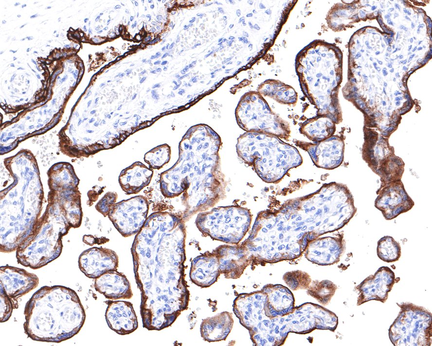 Immunohistochemical analysis of paraffin-embedded human seminoma tissue with Rabbit anti-Placental alkaline phosphatase antibody (ET1705-21) at 1/400 dilution.<br />
<br />
The section was pre-treated using heat mediated antigen retrieval with Tris-EDTA buffer (pH 9.0) for 20 minutes. The tissues were blocked in 1% BSA for 20 minutes at room temperature, washed with ddH2O and PBS, and then probed with the primary antibody (ET1705-21) at 1/400 dilution for 1 hour at room temperature. The detection was performed using an HRP conjugated compact polymer system. DAB was used as the chromogen. Tissues were counterstained with hematoxylin and mounted with DPX.