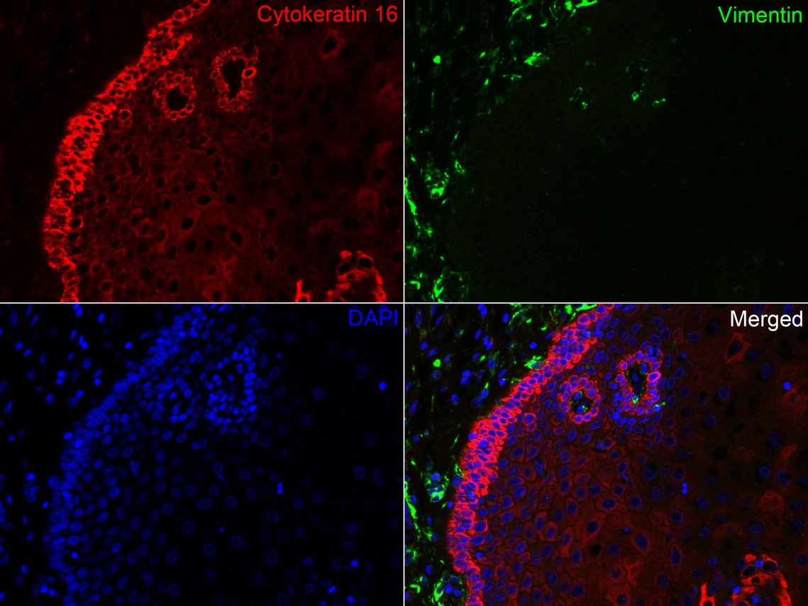 Immunofluorescence analysis of paraffin-embedded human esophagus tissue labeling Cytokeratin 16 (ET1610-17) and Vimentin (EM0401).<br />
<br />
The section was pre-treated using heat mediated antigen retrieval with Tris-EDTA buffer (pH 9.0) for 20 minutes. The tissues were blocked in 10% negative goat serum for 1 hour at room temperature, washed with PBS. And then probed with the primary antibodies Cytokeratin 16 (ET1610-17, red) at 1/200 dilution and Vimentin (EM0401, green) at 1/400 dilution at +4℃ overnight, washed with PBS.<br />
<br />
Goat Anti-Rabbit IgG H&L (iFluor™ 594, HA1122) and Goat Anti-Mouse IgG H&L (iFluor™ 488, HA1125) were used as the secondary antibodies at 1/1,000 dilution. Nuclei were counterstained with DAPI (blue).