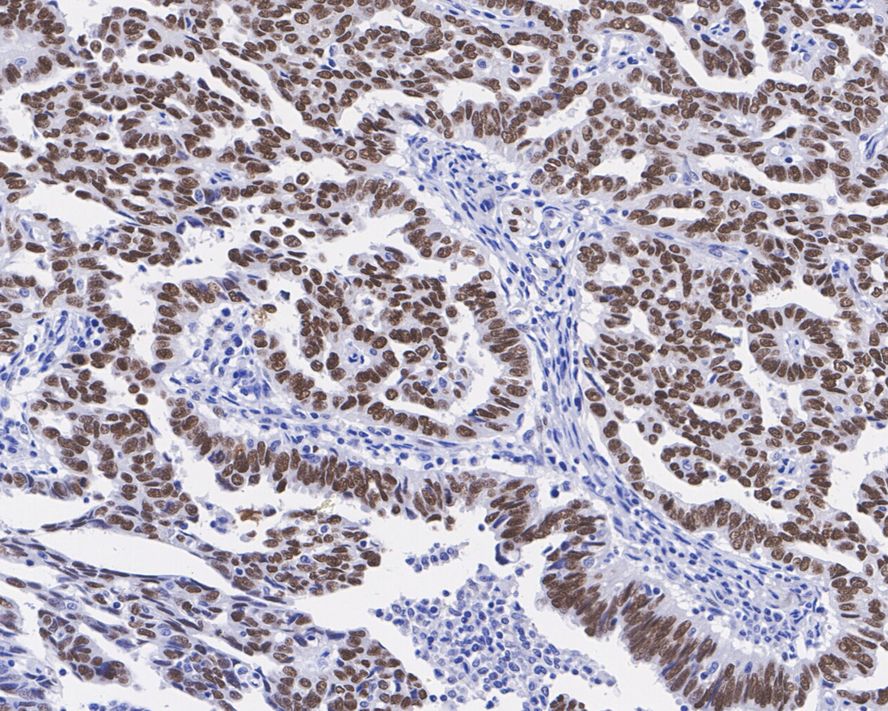 Immunohistochemical analysis of paraffin-embedded human testis tissue with Rabbit anti-Wilms Tumor Protein antibody (ET1610-45) at 1/100 dilution.<br />
<br />
The section was pre-treated using heat mediated antigen retrieval with sodium citrate buffer (pH 6.0) for 2 minutes. The tissues were blocked in 1% BSA for 20 minutes at room temperature, washed with ddH2O and PBS, and then probed with the primary antibody (ET1610-45) at 1/100 dilution for 1 hour at room temperature. The detection was performed using an HRP conjugated compact polymer system. DAB was used as the chromogen. Tissues were counterstained with hematoxylin and mounted with DPX.