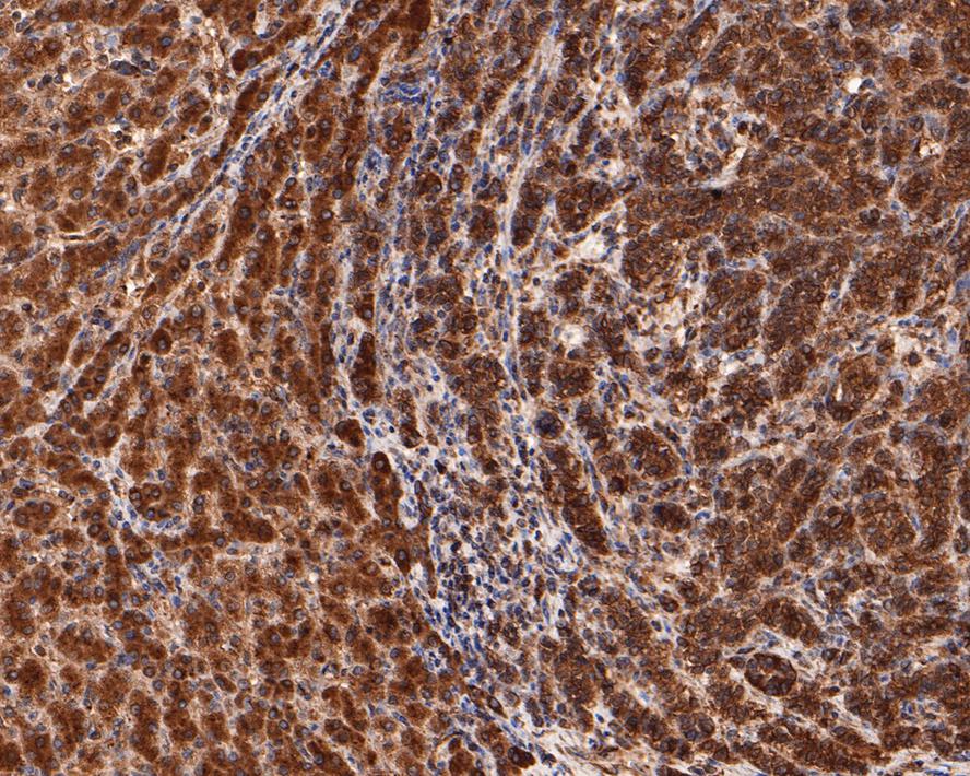 Immunohistochemical analysis of paraffin-embedded human liver carcinoma tissue with Rabbit anti-NLRP3 antibody (ET1610-93) at 1/100 dilution.<br />
<br />
The section was pre-treated using heat mediated antigen retrieval with sodium citrate buffer (pH 6.0) for 2 minutes. The tissues were blocked in 1% BSA for 20 minutes at room temperature, washed with ddH2O and PBS, and then probed with the primary antibody (ET1610-93) at 1/100 dilution for 1 hour at room temperature. The detection was performed using an HRP conjugated compact polymer system. DAB was used as the chromogen. Tissues were counterstained with hematoxylin and mounted with DPX.