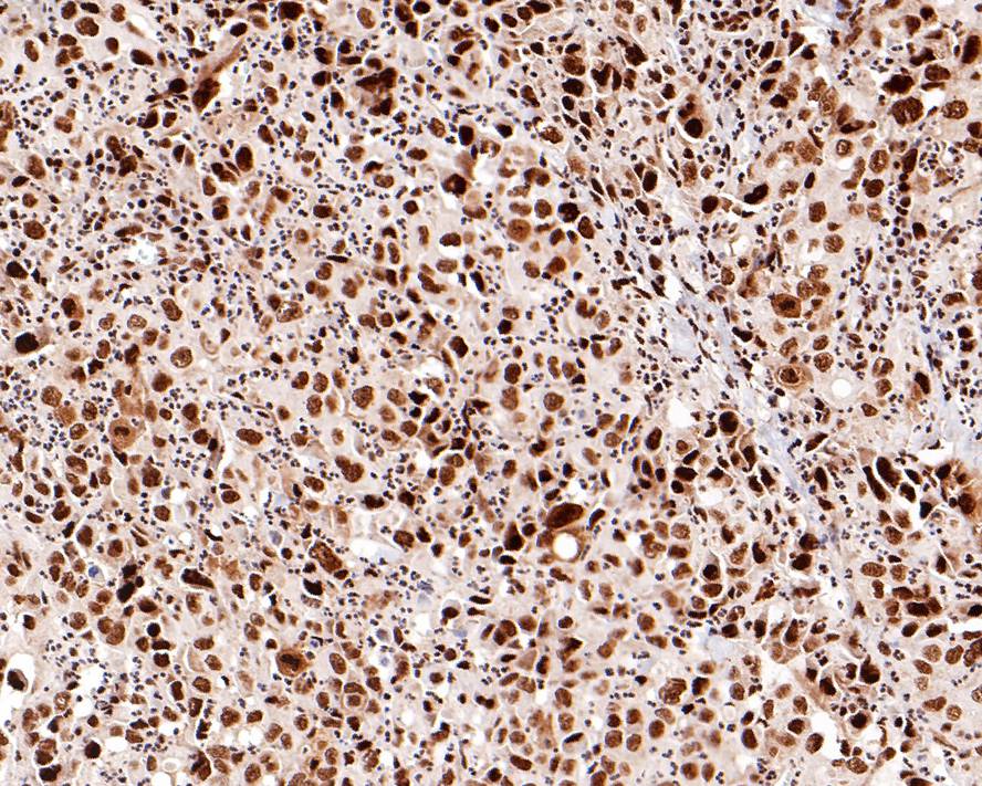 Immunohistochemical analysis of paraffin-embedded human breast invasive ductal tumor tissue with Rabbit anti-Phospho-STAT1(S727) antibody (ET1611-20) at 1/200 dilution.<br />
<br />
A: Untreated human breast invasive ductal tumor tissue<br />
B: λ-PPase treated human breast invasive ductal tumor tissue<br />
C: Negative control<br />
<br />
The section was pre-treated using heat mediated antigen retrieval with Tris-EDTA buffer (pH 9.0) for 20 minutes. The tissues were blocked in 1% BSA for 20 minutes at room temperature, washed with ddH2O and PBS, and then probed with the primary antibody (ET1611-20) at 1/200 dilution for 1 hour at room temperature. The detection was performed using an HRP conjugated compact polymer system. DAB was used as the chromogen. Tissues were counterstained with hematoxylin and mounted with DPX.