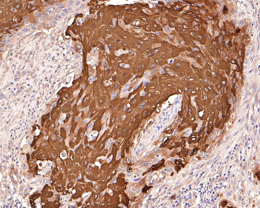 Immunohistochemical analysis of paraffin-embedded human cervical carcinoma tissue with Rabbit anti-Phospho-Hsp27(S78) antibody (ET1701-19) at 1/400 dilution.<br />
<br />
The section was pre-treated using heat mediated antigen retrieval with Tris-EDTA buffer (pH 9.0) for 20 minutes. The tissues were blocked in 1% BSA for 20 minutes at room temperature, washed with ddH2O and PBS, and then probed with the primary antibody (ET1701-19) at 1/400 dilution for 1 hour at room temperature. The detection was performed using an HRP conjugated compact polymer system. DAB was used as the chromogen. Tissues were counterstained with hematoxylin and mounted with DPX.