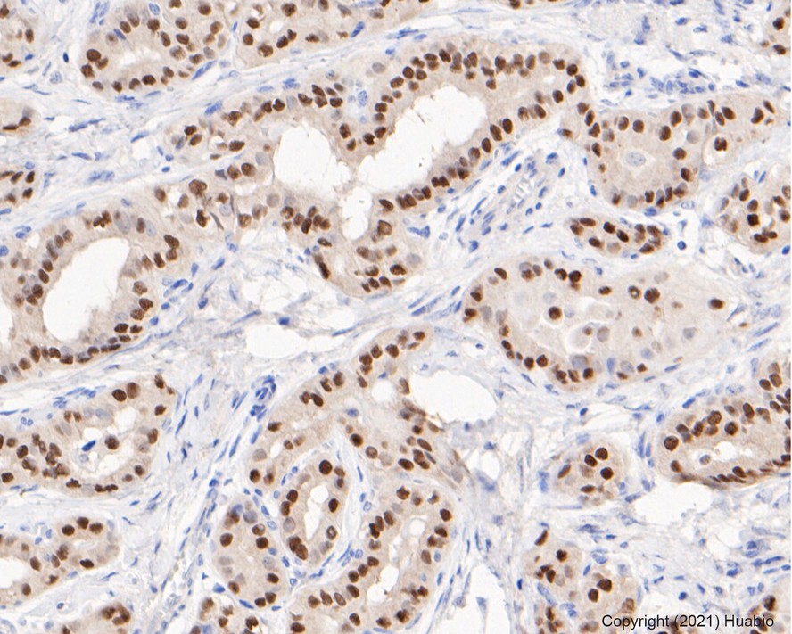 Immunohistochemical analysis of paraffin-embedded human kidney tissue with Rabbit anti-PAX8 antibody (ET1701-50) at 1/500 dilution.<br />
<br />
The section was pre-treated using heat mediated antigen retrieval with sodium citrate buffer (pH 6.0) for 2 minutes. The tissues were blocked in 1% BSA for 20 minutes at room temperature, washed with ddH2O and PBS, and then probed with the primary antibody (ET1701-50) at 1/500 dilution for 1 hour at room temperature. The detection was performed using an HRP conjugated compact polymer system. DAB was used as the chromogen. Tissues were counterstained with hematoxylin and mounted with DPX.