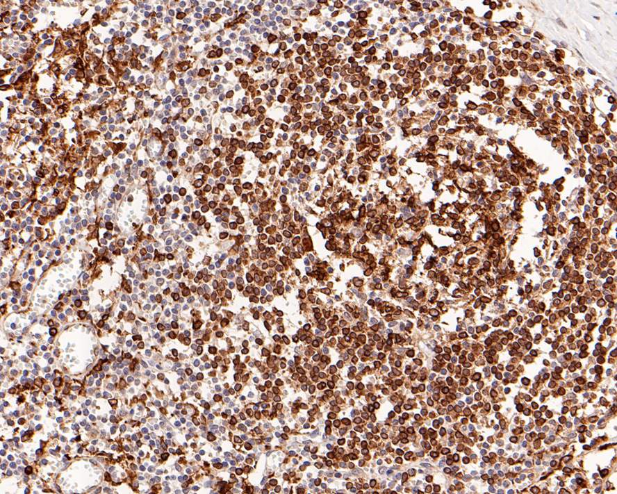 Immunohistochemical analysis of paraffin-embedded human lymph <br />
nodes tissue with Rabbit anti-CD74 antibody (ET1702-51) at 1/500 dilution.<br />
<br />
The section was pre-treated using heat mediated antigen retrieval with Tris-EDTA buffer (pH 9.0) for 20 minutes. The tissues were blocked in 1% BSA for 20 minutes at room temperature, washed with ddH2O and PBS, and then probed with the primary antibody (ET1702-51) at 1/500 dilution for 1 hour at room temperature. The detection was performed using an HRP conjugated compact polymer system. DAB was used as the chromogen. Tissues were counterstained with hematoxylin and mounted with DPX.