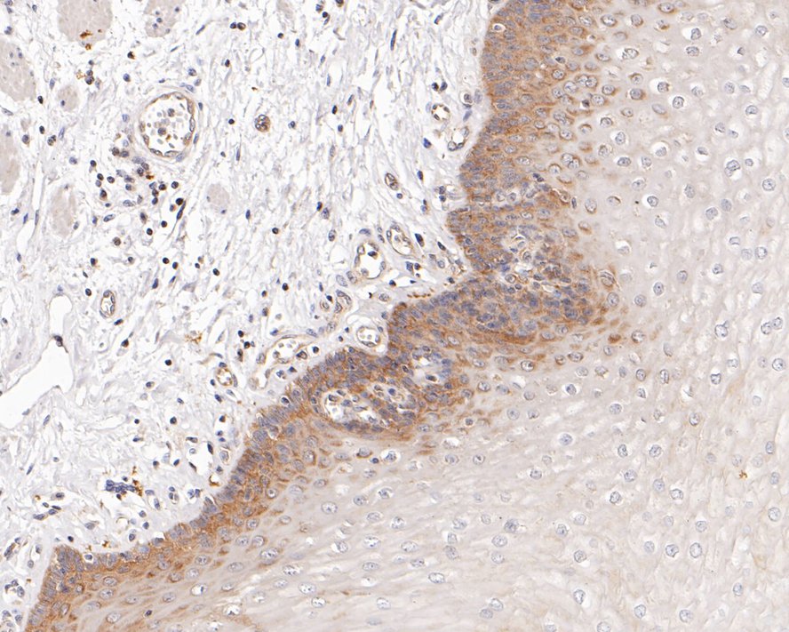 Immunohistochemical analysis of paraffin-embedded human esophagus tissue with Rabbit anti-Phospho-PP2A(Y307) antibody (ET1609-40) at 1/200 dilution.<br />
<br />
The section was pre-treated using heat mediated antigen retrieval with Tris-EDTA buffer (pH 9.0) for 20 minutes. The tissues were blocked in 1% BSA for 20 minutes at room temperature, washed with ddH2O and PBS, and then probed with the primary antibody (ET1609-40) at 1/200 dilution for 1 hour at room temperature. The detection was performed using an HRP conjugated compact polymer system. DAB was used as the chromogen. Tissues were counterstained with hematoxylin and mounted with DPX.