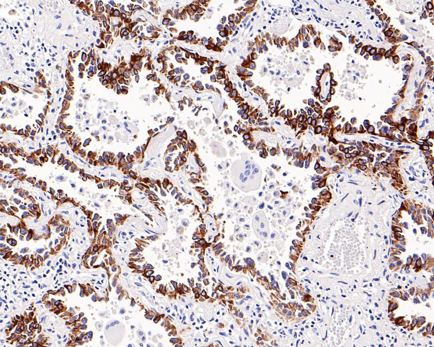 Immunohistochemical analysis of paraffin-embedded human lung carcinoma tissue with Mouse anti-Cytokeratin 7 antibody (EM0702) at 1/200 dilution.<br />
<br />
The section was pre-treated using heat mediated antigen retrieval with Tris-EDTA buffer (pH 9.0) for 20 minutes. The tissues were blocked in 1% BSA for 20 minutes at room temperature, washed with ddH2O and PBS, and then probed with the primary antibody (EM0702) at 1/200 dilution for 1 hour at room temperature. The detection was performed using an HRP conjugated compact polymer system. DAB was used as the chromogen. Tissues were counterstained with hematoxylin and mounted with DPX.
