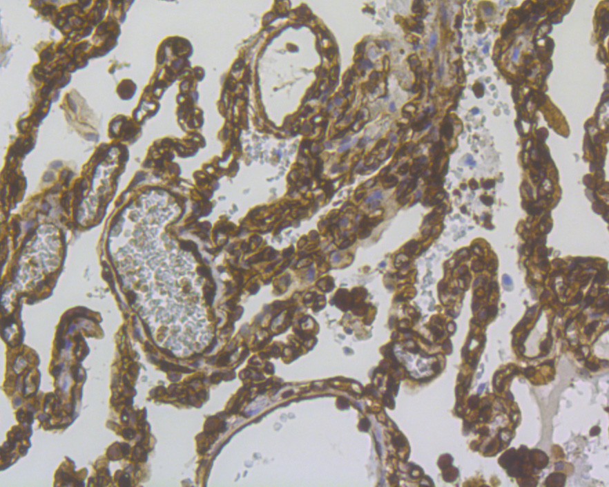 Immunohistochemical analysis of paraffin-embedded human lung cancer tissue with Rabbit anti-Phospho-EGFR (Y1092) antibody (ET1606-44) at 1/200 dilution.<br />
<br />
The section was pre-treated using heat mediated antigen retrieval with Tris-EDTA buffer (pH 9.0) for 20 minutes. The tissues were blocked in 1% BSA for 20 minutes at room temperature, washed with ddH2O and PBS, and then probed with the primary antibody (ET1606-44) at 1/200 dilution for 1 hour at room temperature. The detection was performed using an HRP conjugated compact polymer system. DAB was used as the chromogen. Tissues were counterstained with hematoxylin and mounted with DPX.
