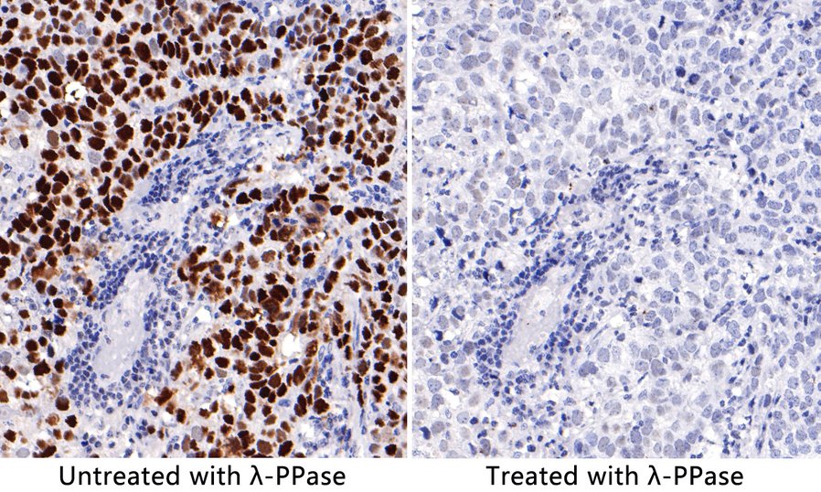 Immunohistochemical analysis of paraffin-embedded Human gastric adenocarcinoma tissue untreaed and treated with λ-PPase with Rabbit anti-Phospho-p53 (S392) antibody (ET1606-24) at 1/200 dilution.<br />
<br />
The section was pre-treated using heat mediated antigen retrieval with sodium citrate buffer (pH 6.0) for 2 minutes. The tissues were blocked in 1% BSA for 20 minutes at room temperature, washed with ddH2O and PBS, and then probed with the primary antibody (ET1606-24) at 1/200 dilution for 1 hour at room temperature. The detection was performed using an HRP conjugated compact polymer system. DAB was used as the chromogen. Tissues were counterstained with hematoxylin and mounted with DPX.