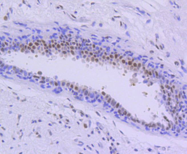Immunohistochemical analysis of paraffin-embedded human breast tissue with Rabbit anti-PIM1 antibody (ET1609-57) at 1/400 dilution.<br />
<br />
The section was pre-treated using heat mediated antigen retrieval with sodium citrate buffer (pH 6.0) for 2 minutes. The tissues were blocked in 1% BSA for 20 minutes at room temperature, washed with ddH2O and PBS, and then probed with the primary antibody (ET1609-57) at 1/400 dilution for 1 hour at room temperature. The detection was performed using an HRP conjugated compact polymer system. DAB was used as the chromogen. Tissues were counterstained with hematoxylin and mounted with DPX.
