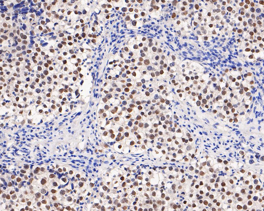 Immunohistochemical analysis of paraffin-embedded human seminoma tissue with Rabbit anti-Nanog antibody (ET1610-2) at 1/800 dilution.<br />
<br />
The section was pre-treated using heat mediated antigen retrieval with sodium citrate buffer (pH 6.0) for 2 minutes. The tissues were blocked in 1% BSA for 20 minutes at room temperature, washed with ddH2O and PBS, and then probed with the primary antibody (ET1610-2) at 1/800 dilution for 1 hour at room temperature. The detection was performed using an HRP conjugated compact polymer system. DAB was used as the chromogen. Tissues were counterstained with hematoxylin and mounted with DPX.