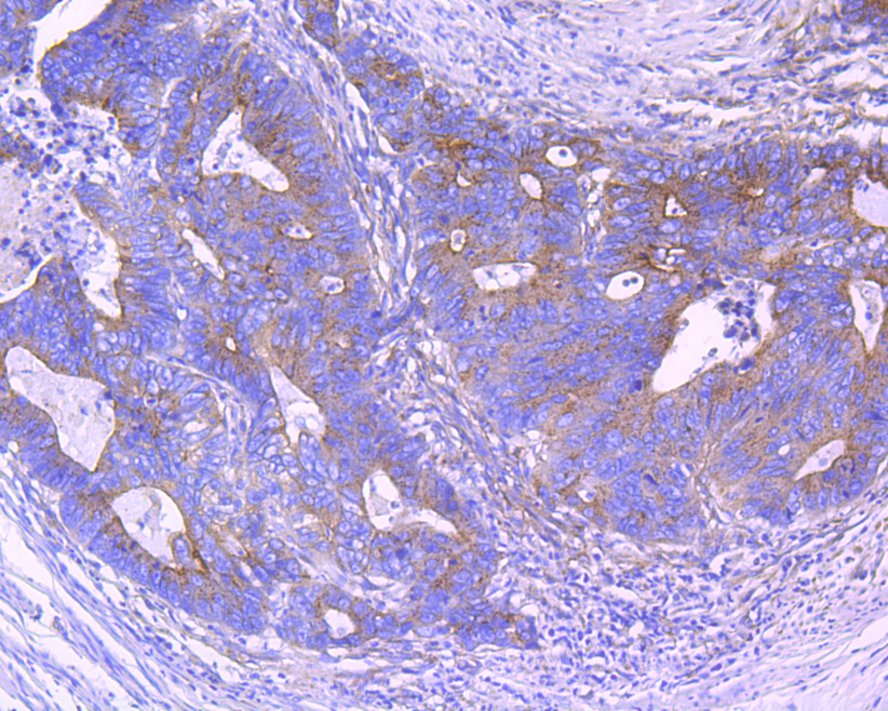 Immunohistochemical analysis of paraffin-embedded human colon cancer tissue using anti-Clathrin heavy chain antibody. Counter stained with hematoxylin.