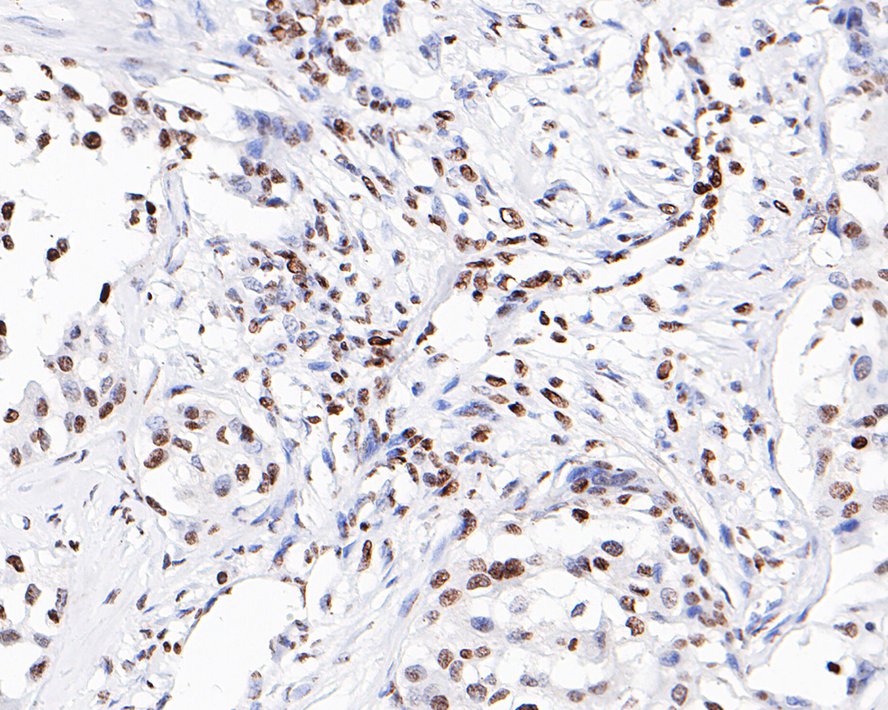 Immunohistochemical analysis of paraffin-embedded human breast carcinoma tissue with Rabbit anti-Histone H3(acetyl K56) antibody (ET1608-9) at 1/200 dilution.<br />
<br />
The section was pre-treated using heat mediated antigen retrieval with sodium citrate buffer (pH 6.0) for 2 minutes. The tissues were blocked in 1% BSA for 20 minutes at room temperature, washed with ddH2O and PBS, and then probed with the primary antibody (ET1608-9) at 1/200 dilution for 1 hour at room temperature. The detection was performed using an HRP conjugated compact polymer system. DAB was used as the chromogen. Tissues were counterstained with hematoxylin and mounted with DPX.