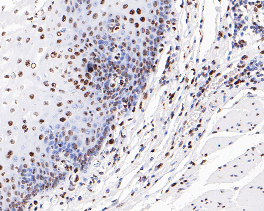 Immunohistochemical analysis of paraffin-embedded human esophageal carcinoma tissue with Rabbit anti-Histone H3(acetyl K56) antibody (ET1608-9) at 1/200 dilution.<br />
<br />
The section was pre-treated using heat mediated antigen retrieval with sodium citrate buffer (pH 6.0) for 2 minutes. The tissues were blocked in 1% BSA for 20 minutes at room temperature, washed with ddH2O and PBS, and then probed with the primary antibody (ET1608-9) at 1/200 dilution for 1 hour at room temperature. The detection was performed using an HRP conjugated compact polymer system. DAB was used as the chromogen. Tissues were counterstained with hematoxylin and mounted with DPX.