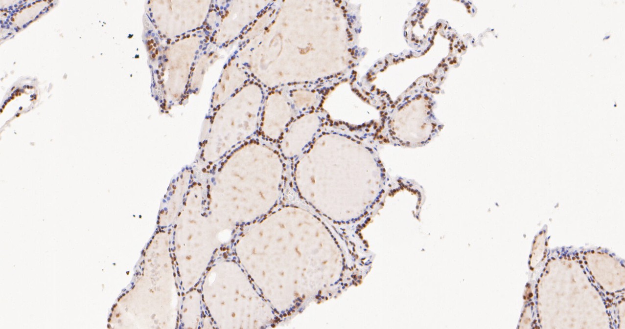 Immunohistochemical analysis of paraffin-embedded human thyroid tissue with Rabbit anti-Islet 1 antibody (ET1610-33) at 1/200 dilution.<br />
<br />
The section was pre-treated using heat mediated antigen retrieval with sodium citrate buffer (pH 6.0) for 2 minutes. The tissues were blocked in 1% BSA for 20 minutes at room temperature, washed with ddH2O and PBS, and then probed with the primary antibody (ET1610-33) at 1/200 dilution for 1 hour at room temperature. The detection was performed using an HRP conjugated compact polymer system. DAB was used as the chromogen. Tissues were counterstained with hematoxylin and mounted with DPX.