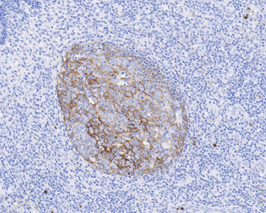 Immunohistochemical analysis of paraffin-embedded human lymph nodes tissue with Rabbit anti-CD11b antibody (ET1706-04) at 1/200 dilution.<br />
<br />
The section was pre-treated using heat mediated antigen retrieval with Tris-EDTA buffer (pH 9.0) for 20 minutes. The tissues were blocked in 1% BSA for 20 minutes at room temperature, washed with ddH2O and PBS, and then probed with the primary antibody (ET1706-04) at 1/200 dilution for 1 hour at room temperature. The detection was performed using an HRP conjugated compact polymer system. DAB was used as the chromogen. Tissues were counterstained with hematoxylin and mounted with DPX.